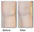 Endovenous Laser Treatment - Before and After by Oakville Vascular - Oakville, Ontario CANADA